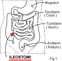ileostomi är en stomi på tunntarmen