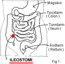 Ileostomi, tecknad