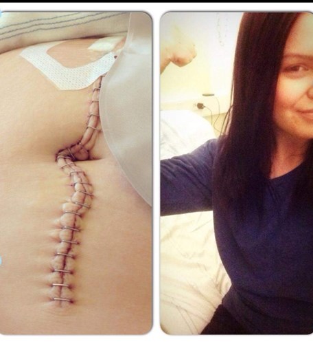 Till vänster: Erikas sår på magen efter operationen. Till höger: Erika sitter på en sjukhussäng, hon ler och gör en stark-arm pose.